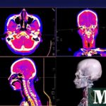 ¿Qué compensación puedes obtener por un derrame cerebral después de una cirugía?