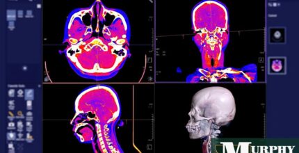 que compensacion puedes obtener por un derrame cerebral despues de una cirugia